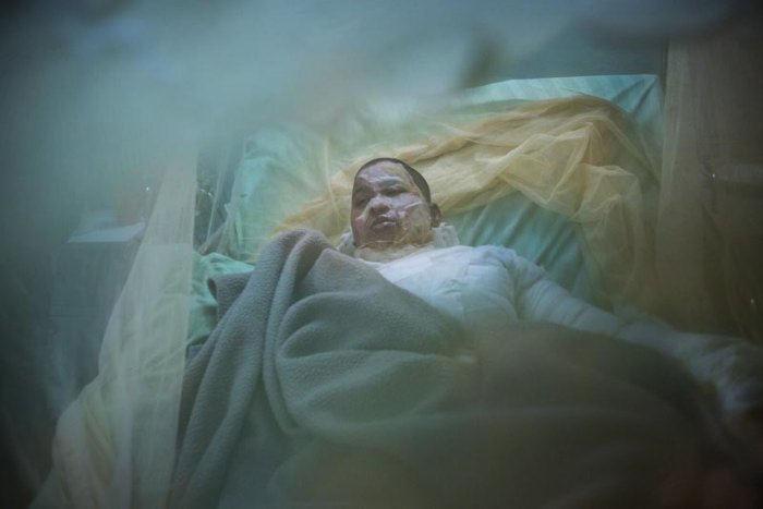 Lingering Scars é o nome da série de fotos criada pela fotógrafa Farzana Hossen. Nessa série, ela documenta a vida das mulheres que sobreviveram a ataques de ácido no Bangladesh, onde a violência contra mulheres é crescente.